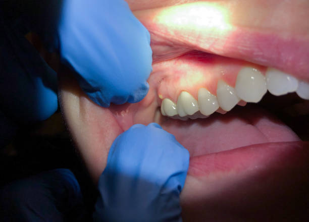 Best Broken Tooth Emergency  in Twin Lakes, VA